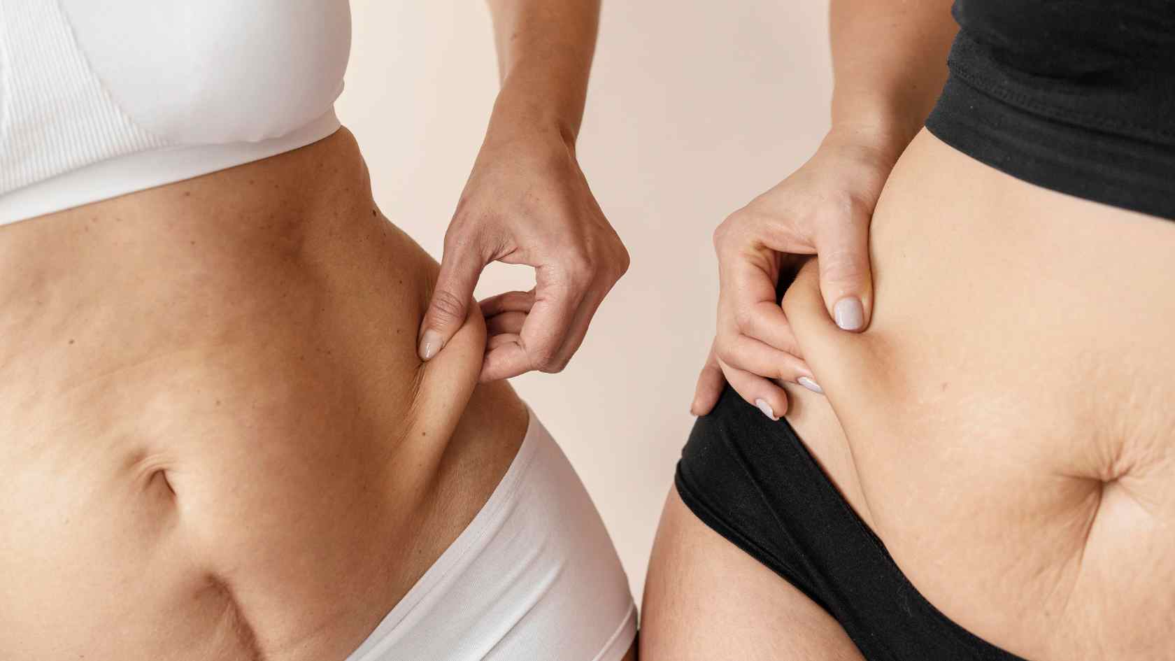 lipedema