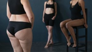 lipedema